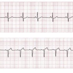 Aacn essentials of ecg and dysrhythmia monitoring answers