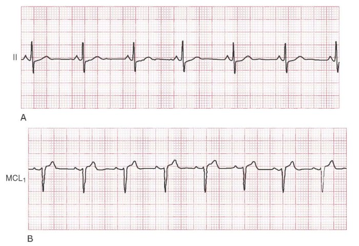 Aacn essentials of ecg and dysrhythmia monitoring answers